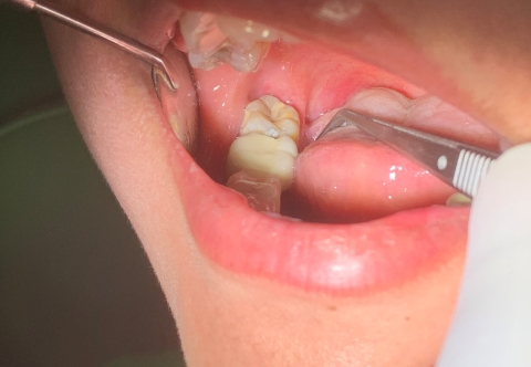 Nhổ răng khôn bằng máy piezotome không đau nhanh lành thương 